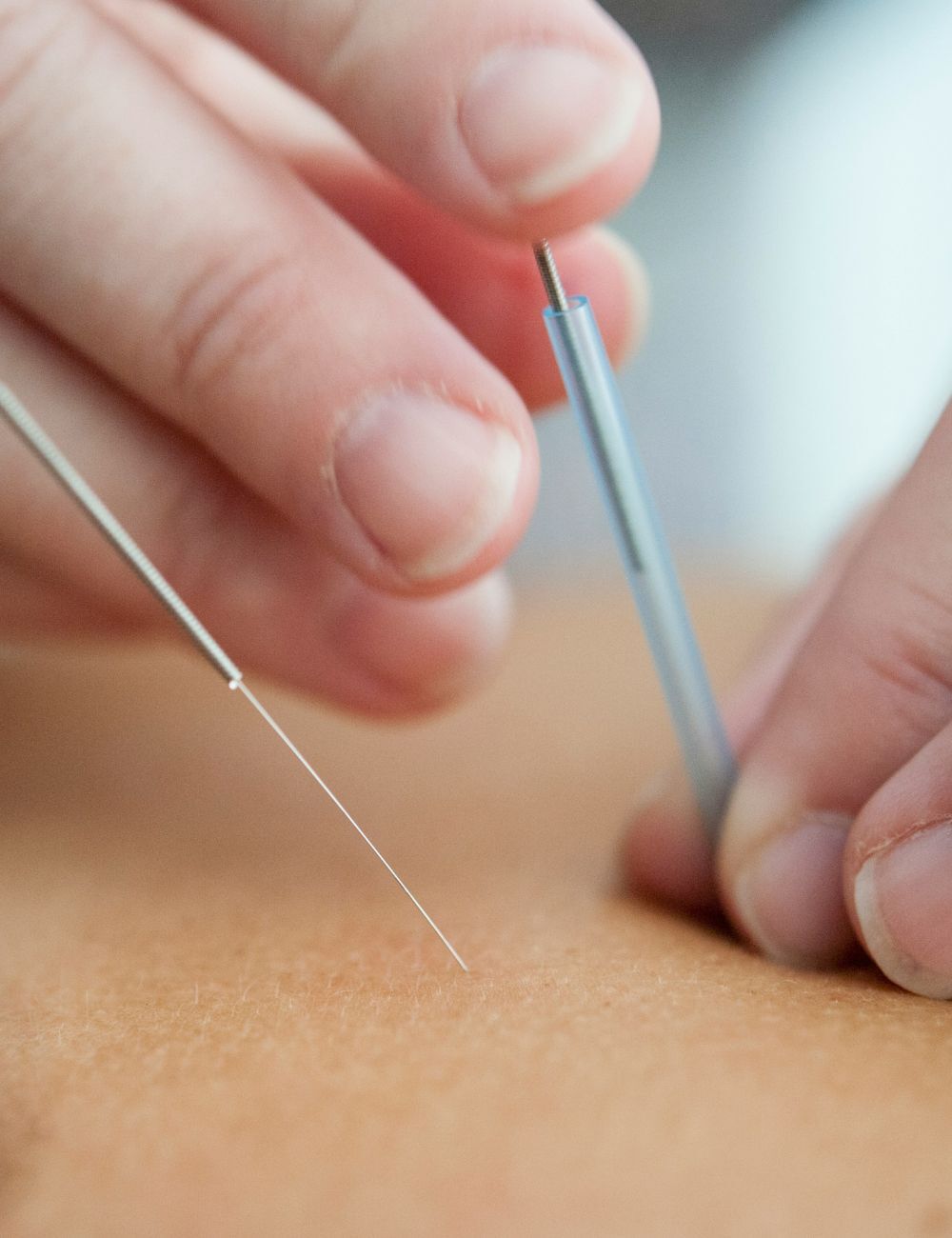 Fertility acupuncture 2