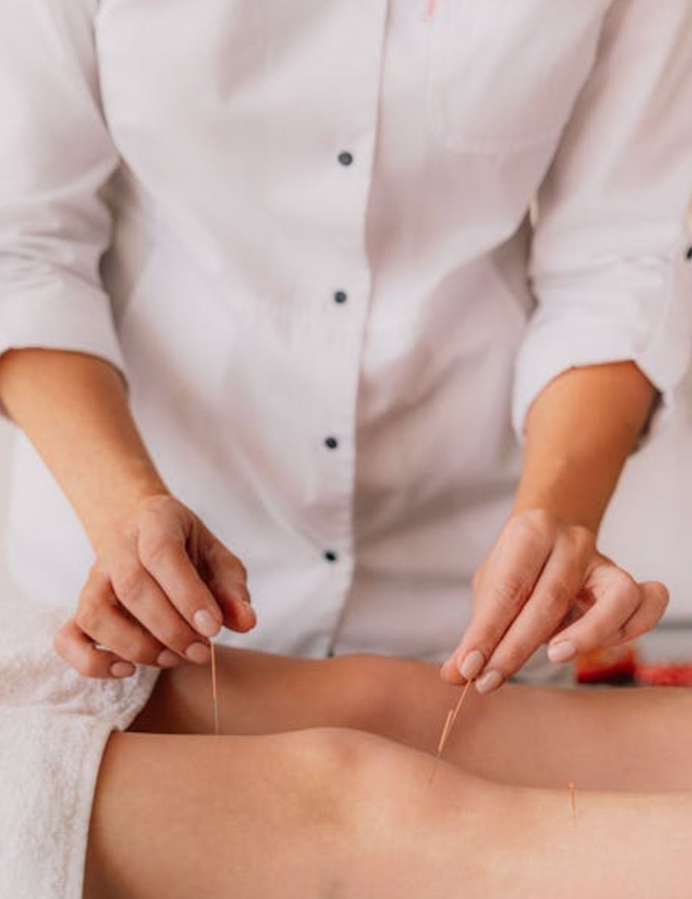 Fertility acupuncture 5